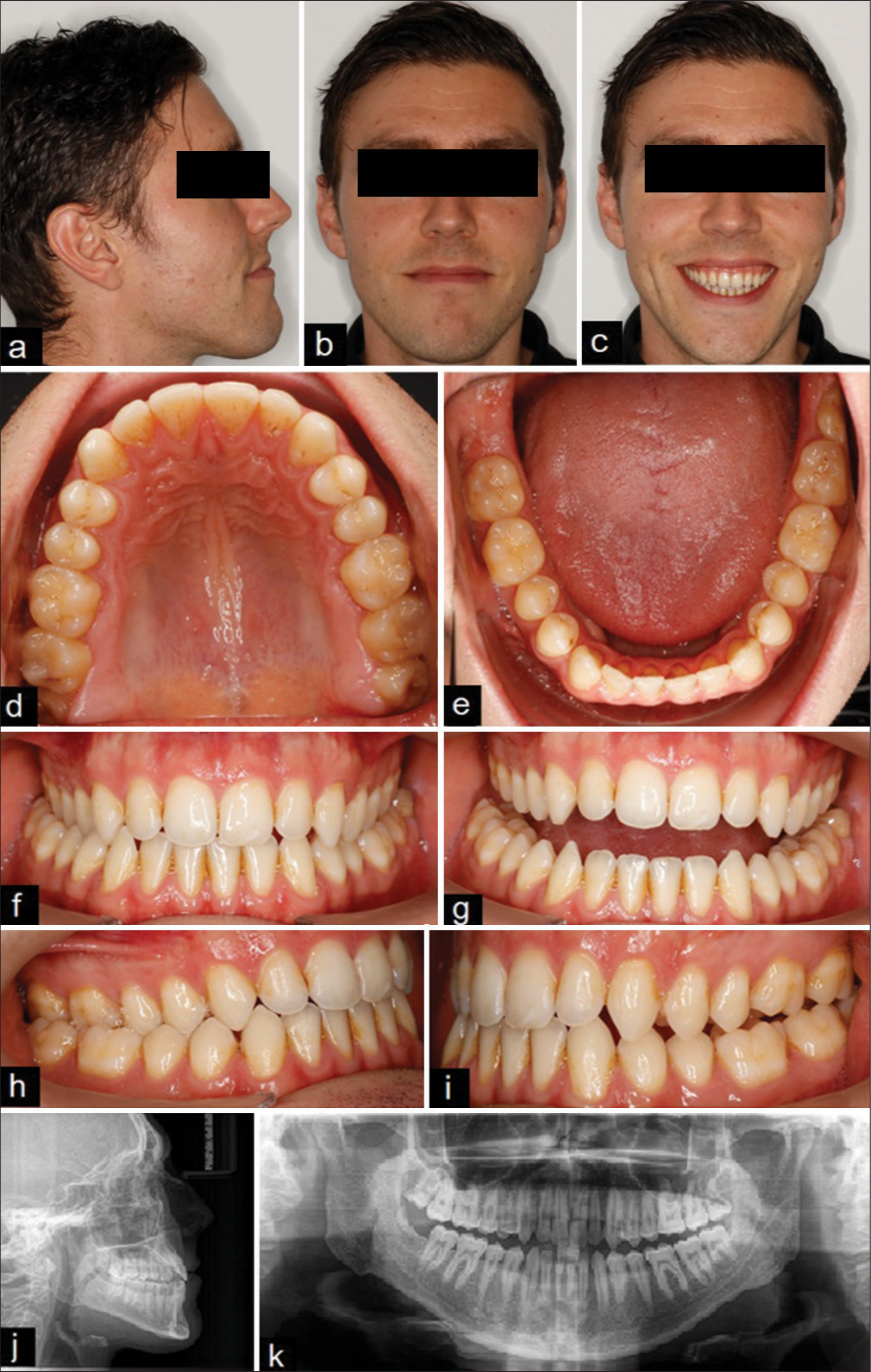 Roll, pitch, and yaw control using targeted mechanics in clear aligner therapy – A case report