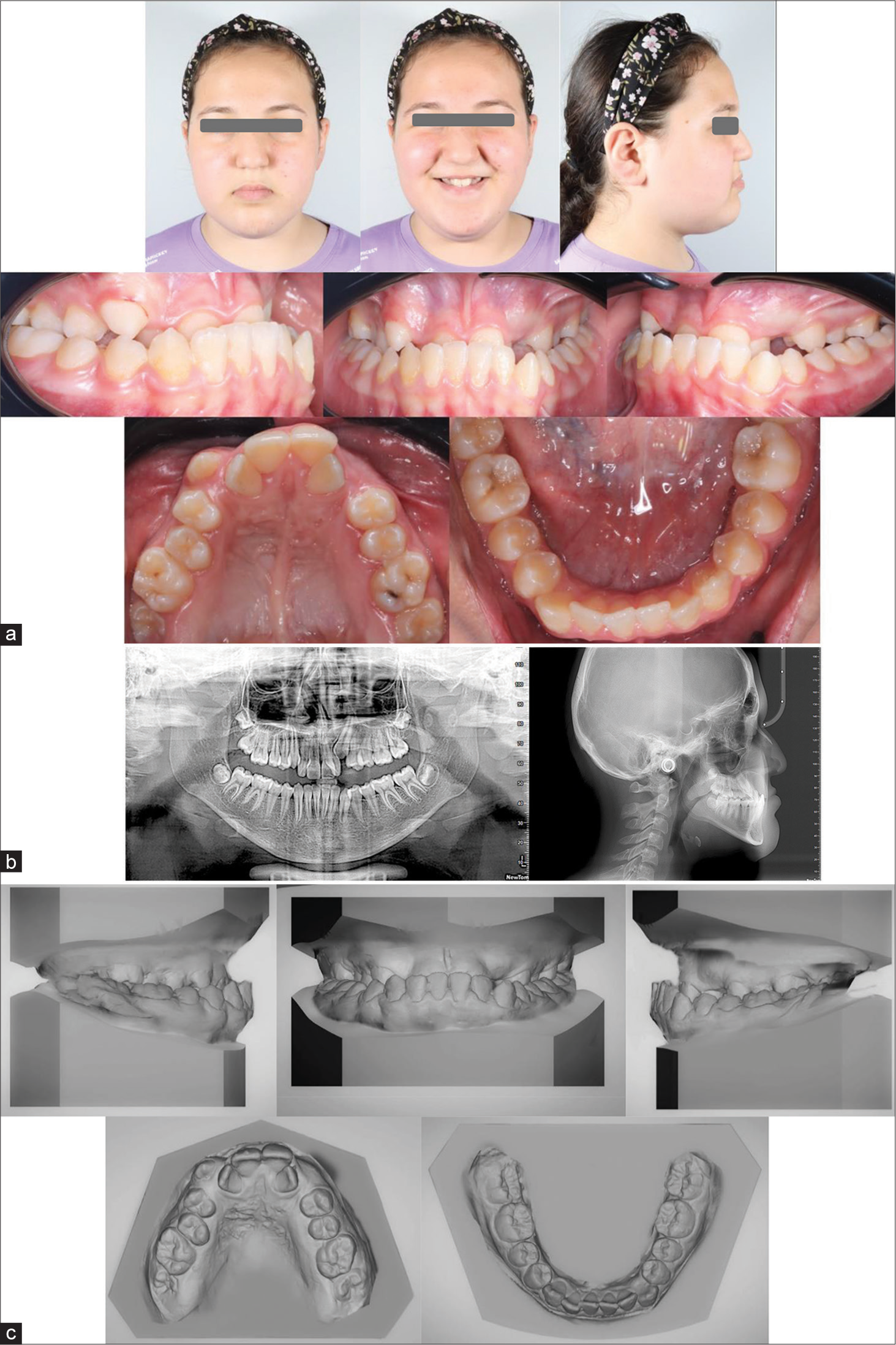 Treatment of severe skeletal Class III patient with buccally impacted canines and severe crowding using a bone-anchored facemask and Alt-RAMEC protocol: A case report