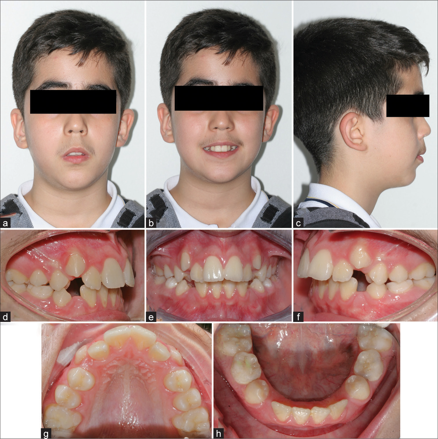 Effects of two-phase treatment with functional appliances versus one-phase treatment with pre-molar extraction in Class II div 1 monozygotic twins: A case study