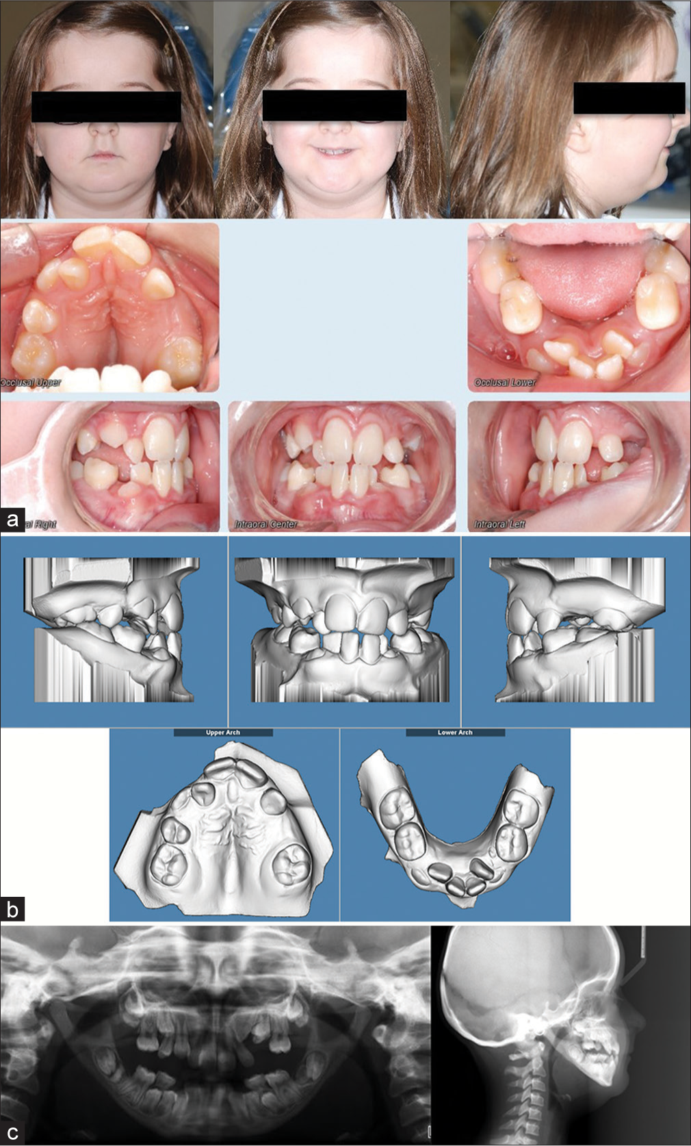 Orthodontic treatment of a patient with pycnodysostosis