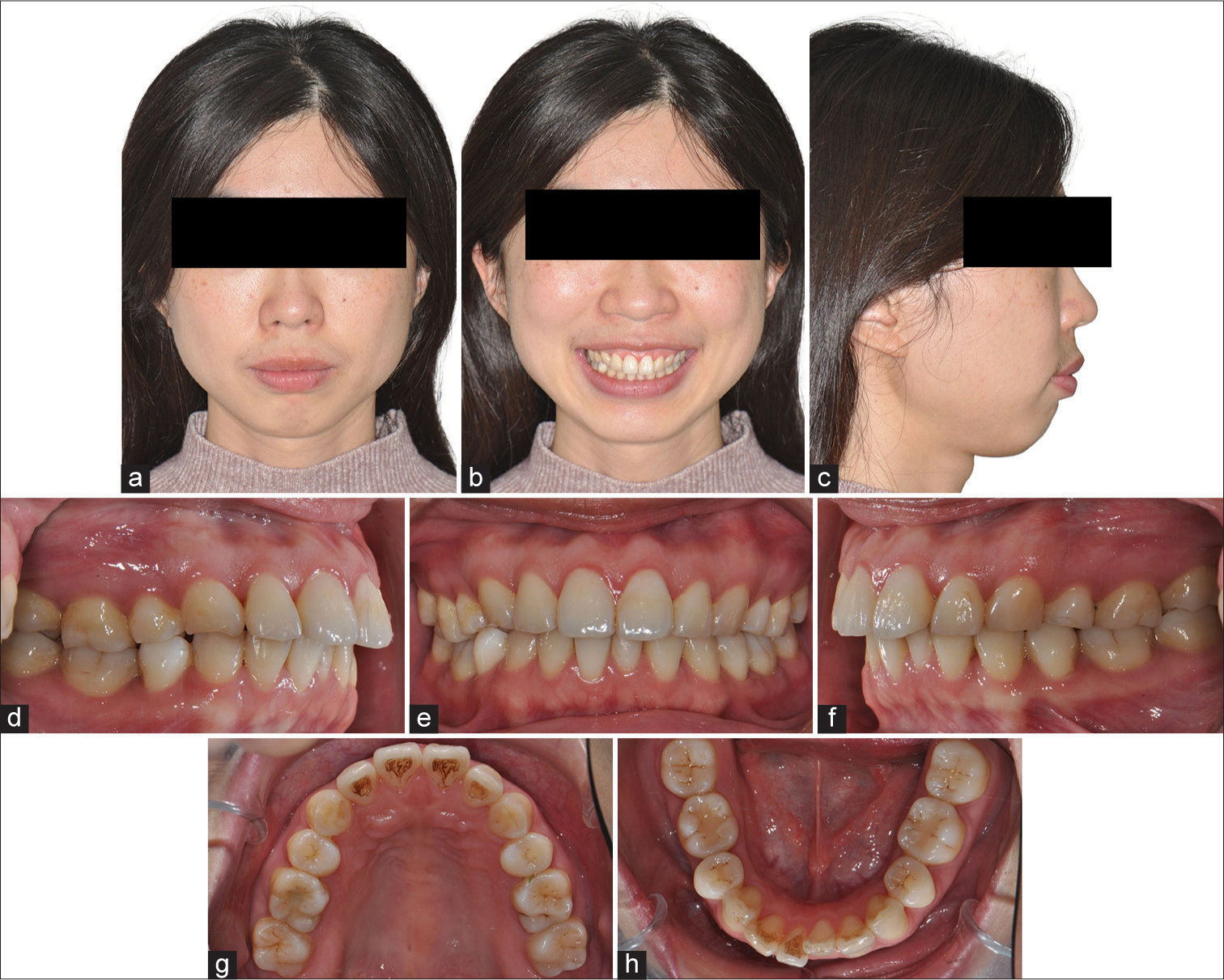 Simplified application of midpalatal miniscrew in the retreatment of a hyperdivergent case – A case report