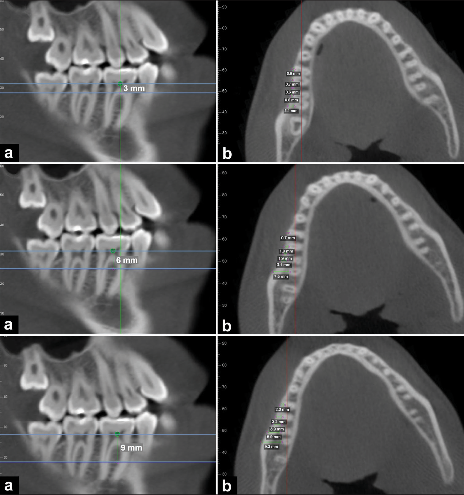 Safe sites in the mandibular buccal shelf for orthodontic mini-screws: Tomographic study in different facial types