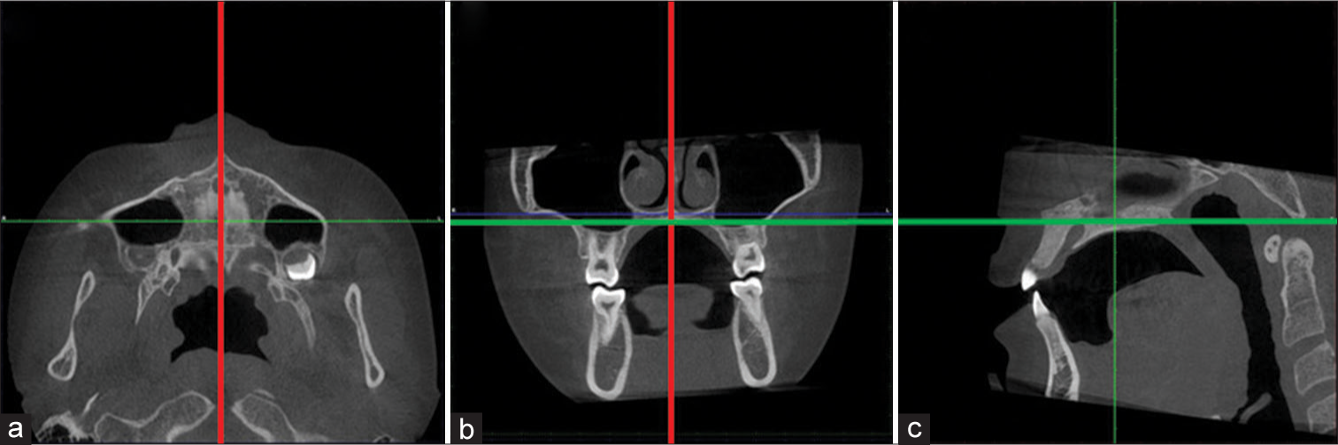 Investigation of the correlation of midpalatal suture maturation stage with chronological age and cervical vertebral maturation stage