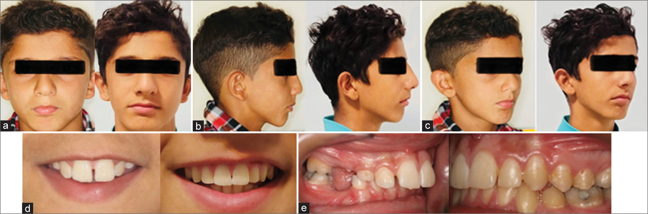 Evaluation of natural head position changes in the treatment of class II malocclusions with functional appliance