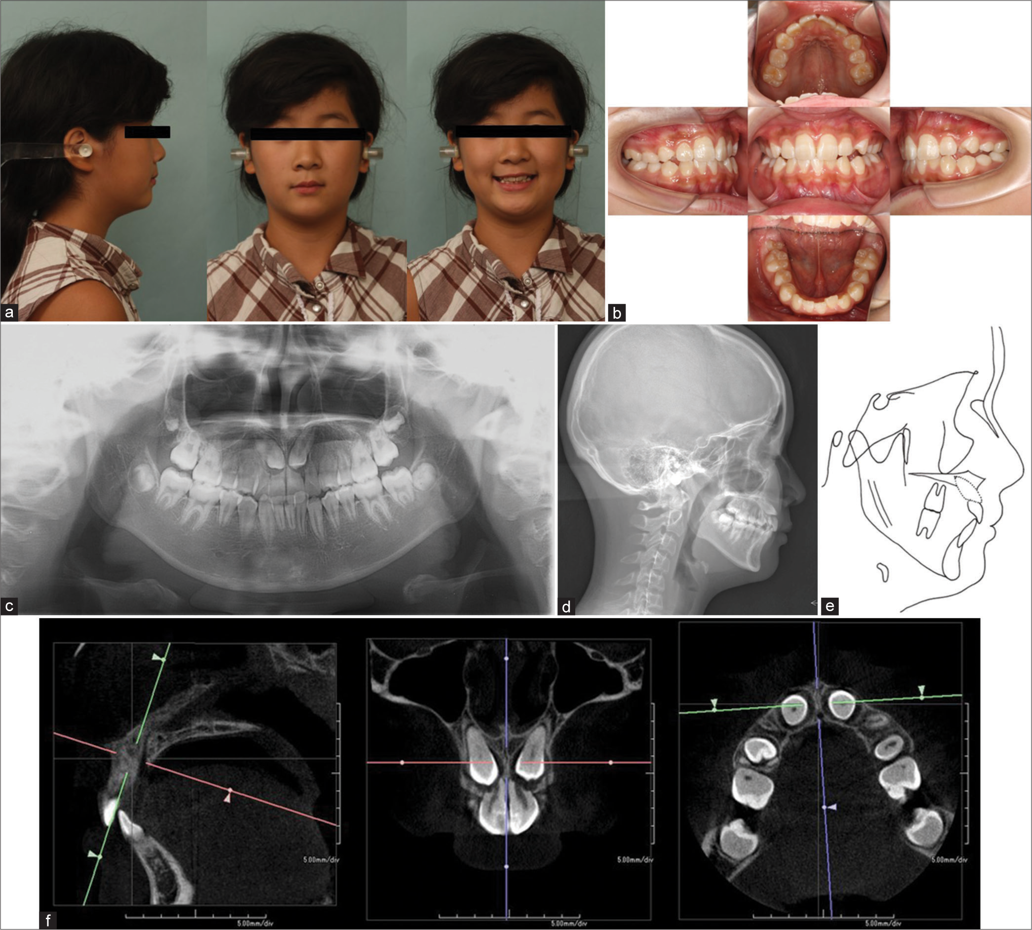 Management of root resorption of anterior teeth caused by impacted canines with emergency traction for replacement of central incisors