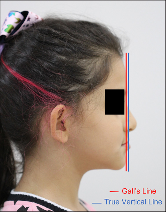 FOCA orthodontic diagnosis method: Facial, occlusal, cephalometric, and anamnesis analysis – Description of the method and instruments applied