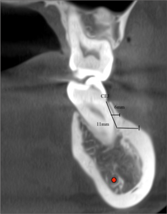 An anatomical evaluation of the mandibular buccal shelf: A cone beam computed tomography study