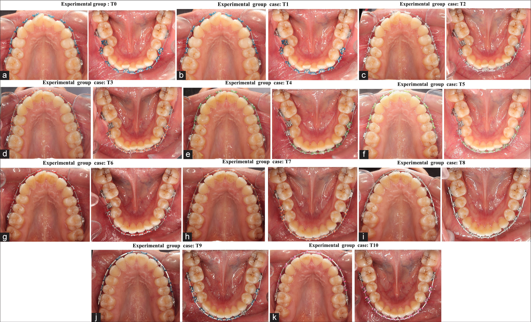 The effects of the twin arch bracket system in class 1 orthodontic patients for a control of orthodontic tooth movement: A randomized controlled clinical trial