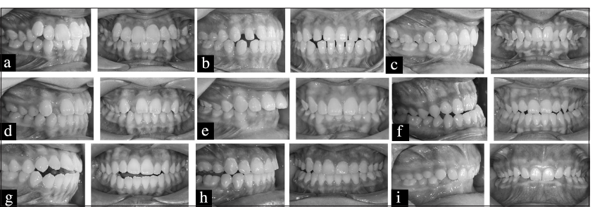 Assessing orthodontic treatment need in virtual consultations: A comparative analysis of photographic evaluations and clinical grading