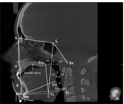 Relationship between malocclusion and state of the upper respiratory tract, position of the tongue and hyoid bone