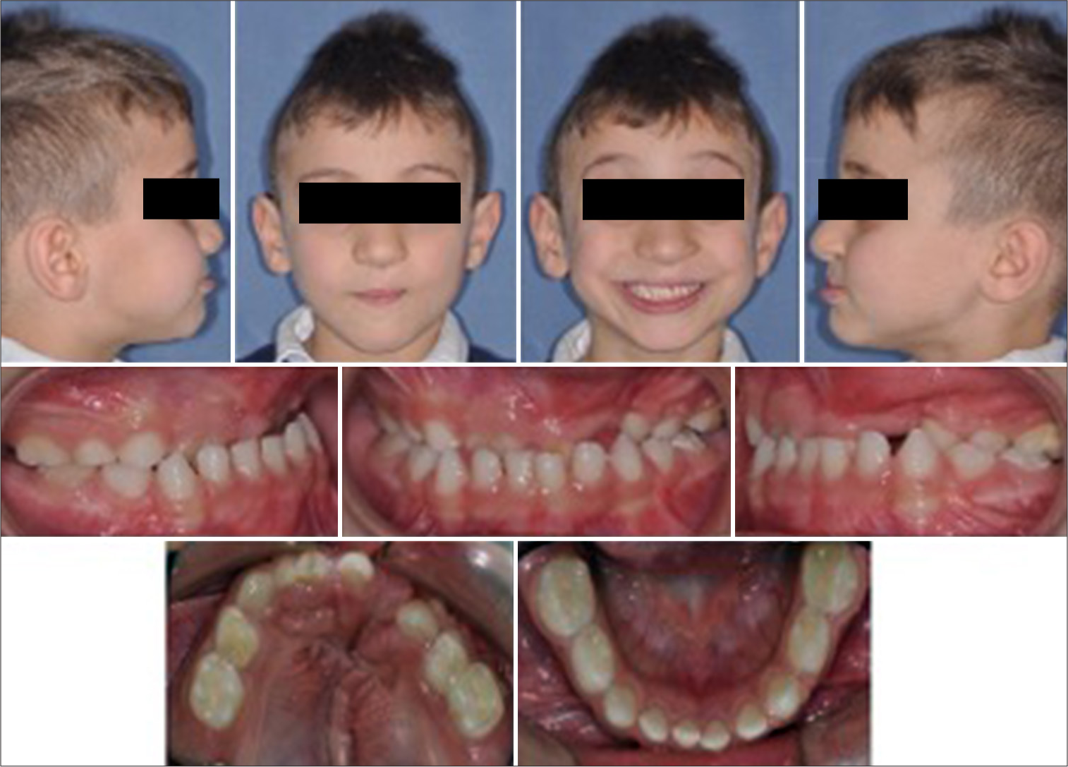 Bonded maxillary expander in growing patients with or without unilateral cleft lip and palate: How does it influence transversal and vertical dentoskeletal changes?