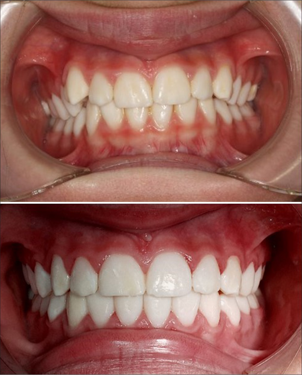 Extensive enamel and dentin destruction associated with the misuse of invisible retainers