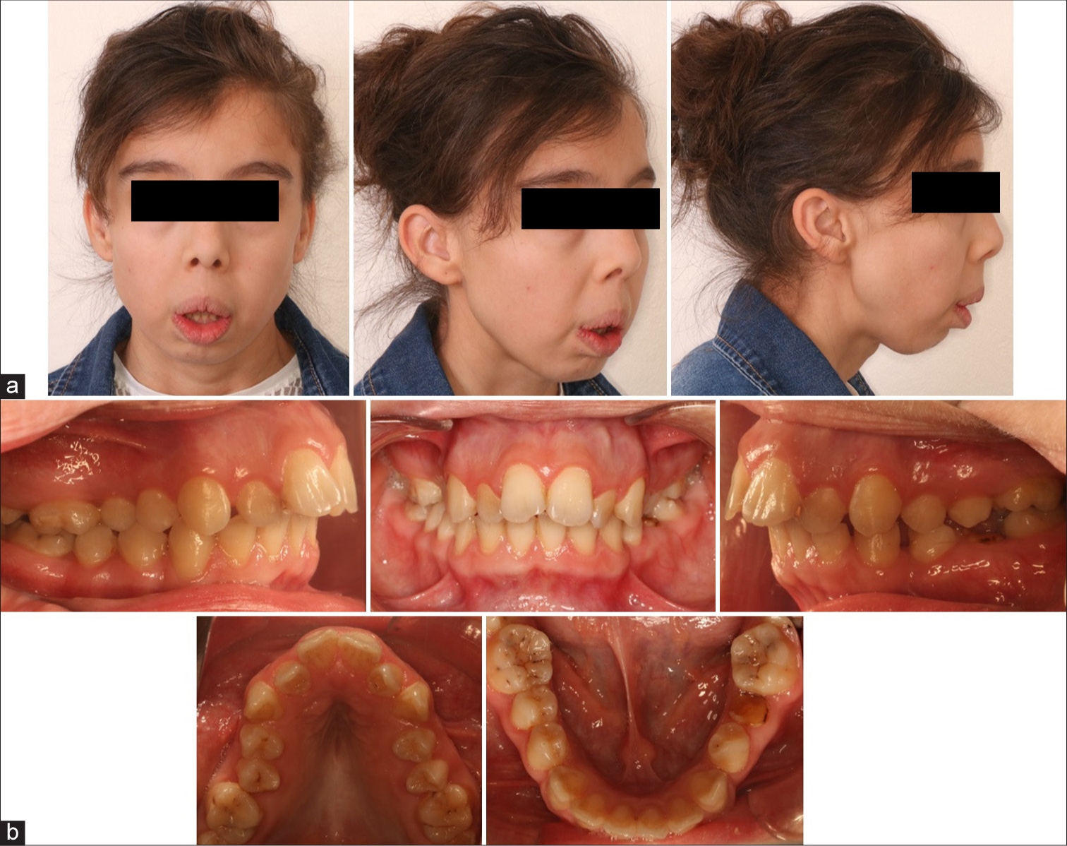 Orthodontic treatment of a patient with cutis laxa