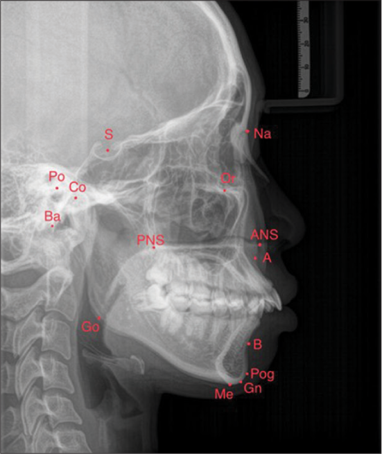 Effects of mini-implant anchorage on mandibular rotation and esthetic outcomes in hyperdivergent skeletal Class II malocclusion treatment