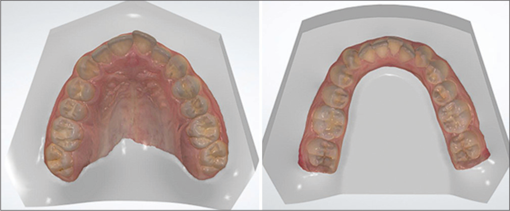 The effect of the presence of brackets on the reliability of measurements made on three-dimensional digital models