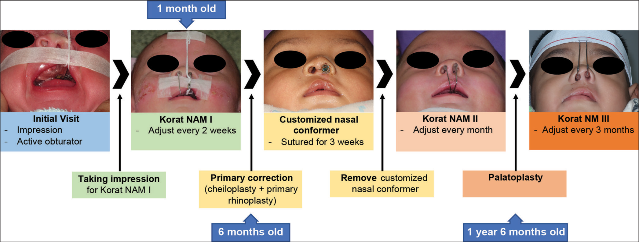 The use of Korat-modified nasoalveolar molding devices in patients with unilateral complete cleft lip and palate with a 5-year follow-up