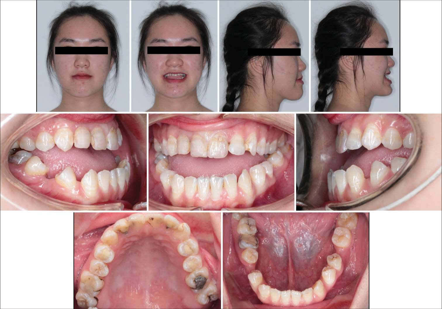 Multidisciplinary orthodontic-orthognathic management of severe skeletal Class III malocclusion and anterior open bite