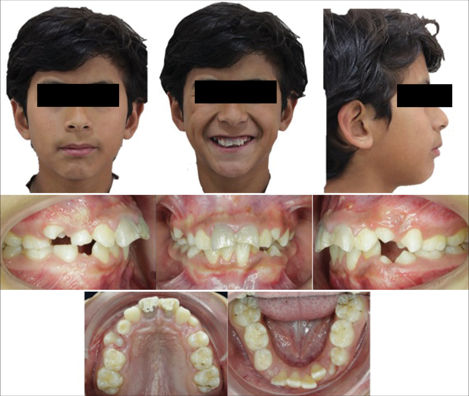 Autotransplanted premolars for substituting traumatic maxillary central incisors in a Class II growing patient