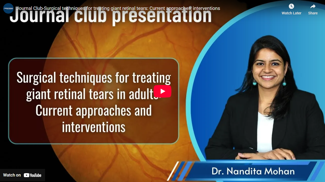 Journal Club-Systematic review of surgical techniques for treating giant retinal tears in adults: A current assessment of approaches and interventions - Video